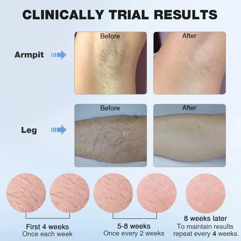 Kskin Painless Ipl Hair Removal